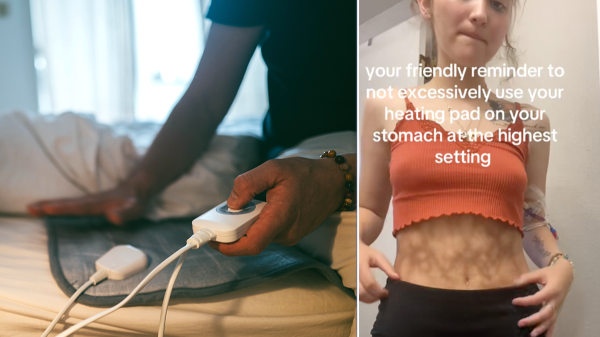 What is &lsquo;toasted skin syndrome'? Heating pads and blankets can cause skin damage, experts warn
