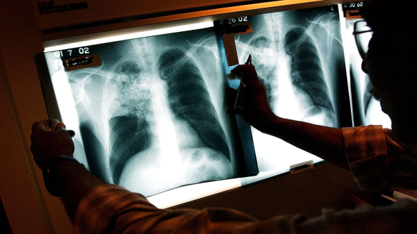 Kansas City tuberculosis outbreak is largest in US history