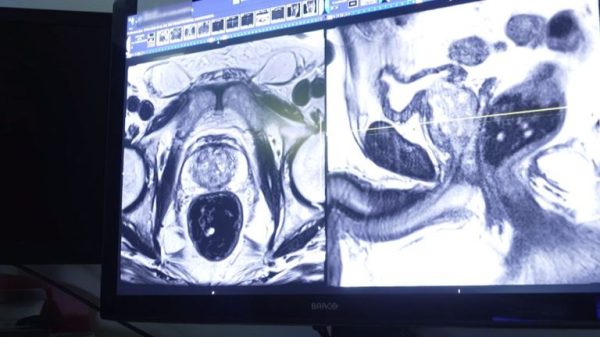 Doctor leading new screening trial warns of 'sharp rise' in prostate cancer if disease not detected earlier