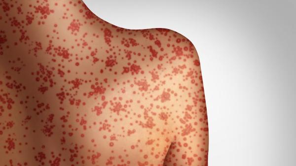 Texas confirms growing measles outbreak affecting school-aged children