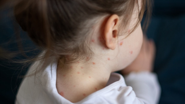 Measles cases continue to spread in multiple states following child’s death Measles cases continue to spread in multiple states following child’s death