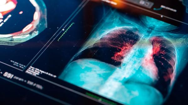 Common pain medication could reduce cancer spread, study finds