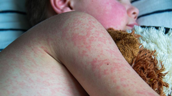 Measles cases in European region doubled last year to highest since 1997, say WHO and UNICEF