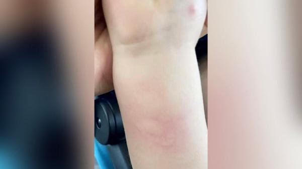 Family kicked off flight over son&rsquo;s insect bites despite doctor&rsquo;s approval